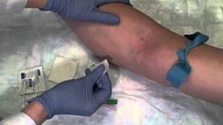 Phlebotomy on Live Patient Straight Needle [upl. by Atterg]