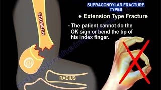 Pediatric fractures Upper Extremity Review  Everything You Need To Know  Dr Nabil Ebraheim [upl. by Ittocs336]