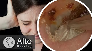 Ear Wax Removal CURES Tinnitus [upl. by Ecneps]