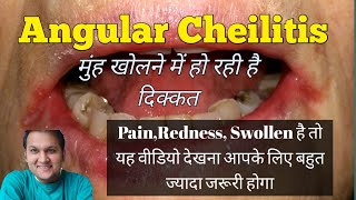 Angular Cheilitis Cause Symptoms Risk Facors and Treatment [upl. by Domash153]