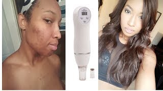 39 Personal Diamond Microdermabrasion REVIEW Go away dark marks [upl. by Eldnek892]