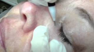 REMOVAL OF FIBROMA NEAR EYE [upl. by Agosto499]