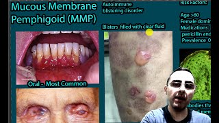 Mucus Membrane Pemphigoid MMP  Symptoms Causes and treatment [upl. by Philippine348]