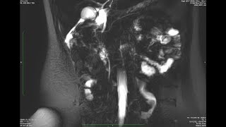 PANCREAS DIVISUM Radiology [upl. by Annovahs]