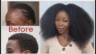 My natural hair journey Hair loss Balding Damage and Regrow  pics and videos [upl. by Mercier]