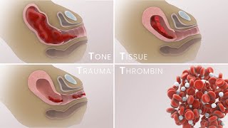 Management of Postpartum Hemorrhage PPH  Etiologies prevention treatment  TVASurg [upl. by Eitsyrhc537]