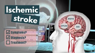 Ischemic Stroke Animation  Symptoms diagnosis treatment amp prognosis [upl. by Anahpets998]