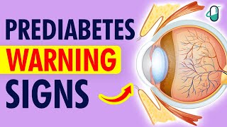 10 Alarming Prediabetes Signs to Watch Out For Reverse It Now [upl. by Aihsenrad]