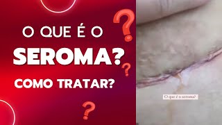 Seroma pós cirúrgico como tratar Líquido amarelado após cirurgia plástica pósoperatório [upl. by Enahpad412]