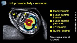 Semilobar holoprosencephaly 2D and 3D ultrasound [upl. by Laband870]