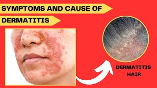 Symptoms and Cause of Dermatitis Disease  Causes  Sign  Your Doctor [upl. by Uziel]