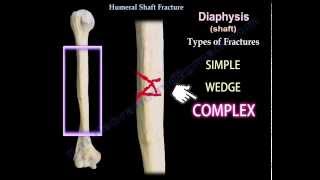 Humeral Shaft Fracture  Everything You Need To Know  Dr Nabil Ebraheim [upl. by Refinnej]