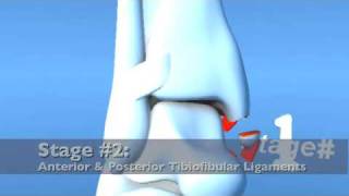 Lauge Hansen PAB Pronation ABduction Eversion Ankle Fracture [upl. by Heimer432]