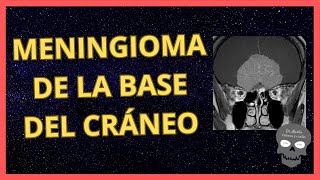 MENINGIOMA de la BASE del CRÁNEO👉Hallazgos RADIOLÓGICOS [upl. by Orhtej]