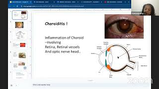 Homoeopathy for Choroiditis [upl. by Hadihahs]