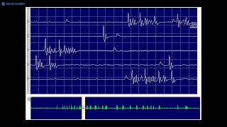 Kimura amp Kohara F34 Typical myokymic discharge seen in a demyelinating neuropathy [upl. by Gennifer]