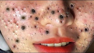 Big Cystic Acne Blackheads Extraction Blackheads amp Milia Whiteheads Removal Pimple Popping  3290 [upl. by Bruell]