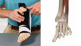 Lateral Ankle Sprains  Treatment and Prevention [upl. by Annayoj]