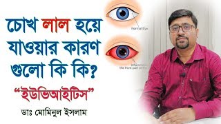 চোখ লাল হয়ে যাওয়ার কারণগুলো কি কি Causes for rednessinflammation of the eye Uveitis [upl. by Rednave]