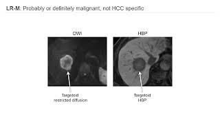 Imaging HCC and LIRADS [upl. by Pascal]