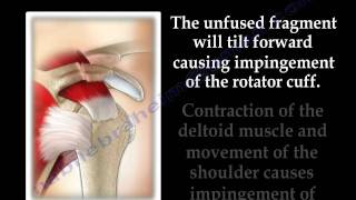 The Acromion Os Acromiale  Everything You Need To Know  Dr Nabil Ebraheim [upl. by Alban]