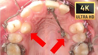 🤔 Journey to PERFECT SMILE😊 Before and After of Rare Transpositions in 4K [upl. by Alpert]