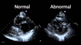 Echocardiogram from the Patient Compared with That from a Normal Control  NEJM [upl. by Garlan646]