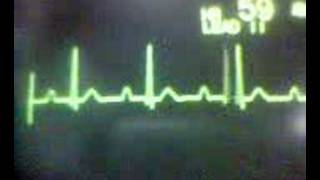 ECG Video AV Block  First Degree [upl. by Yellas]