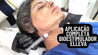 Tratamiento con Radiesse rejuvenecimiento y lifting facial sin cirugía [upl. by Forsta]