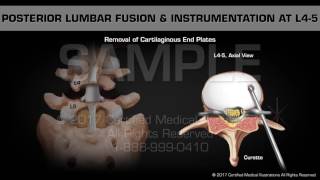 Posterior Lumbar Fusion amp Instrumentation at L45 [upl. by Atteve828]