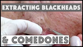 Extracting blackheadscomedones in condition called FavreRacouchot For medical education NSFE [upl. by Isiad]