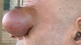 Dermoid Cyst Removal and Treatment [upl. by Manvil]