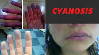 CYANOSIS  Causes Symptoms Types Treatment I What is cyanosis Peripheral and Central Cyanosis [upl. by Jeanine]