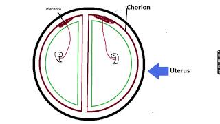 Twins Chorionic amp Amniotic  Identical vs Fraternal  TTTS  USMLE  MCQ [upl. by Cesya]