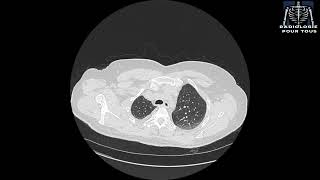 SCANNER THORACIQUE  Pleurésie bilatérale déjà traité pour TBK pulmonaire [upl. by Noseyt22]