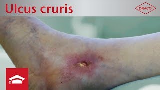 Ulcus cruris venosum und arteriosum Definition Entstehung amp Wundbeschreibung [upl. by Anire]