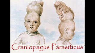 Craniopagus Parasiticus – a parasitic head protruding from temporal area of cranium [upl. by Schild28]