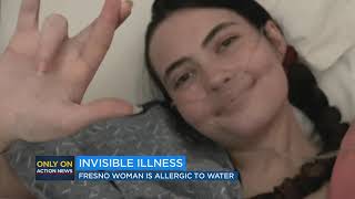 Woman with water allergy describes living with rare condition [upl. by Ahsekahs]