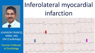 Inferolateral myocardial infarction [upl. by Galen]