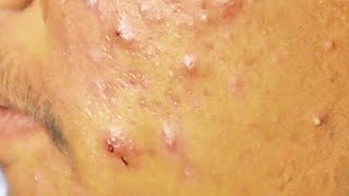 Extraction boutons et drainage le pus suintant dun acné kystique sur le visage  cystic acne [upl. by Hachmann695]