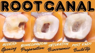 Root Canal Treatment in Maxillary First Molar🟡⚪️TRUNATOMY FILE [upl. by Nairot797]