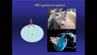 Neurosurgery On the Go Stereotaxis in NeuroOncology [upl. by Assilim734]