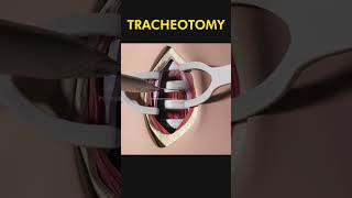 Tracheotomy 😷 explained [upl. by Hiltner439]