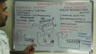 Ameloblastoma management [upl. by Anelrahc]