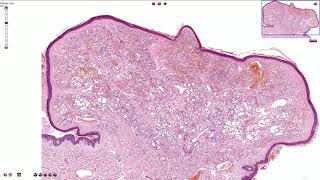 Capillary Hemangioma  Skin Histopathology [upl. by Ham933]