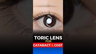 Toric Lens for Cataract Surgery Cost [upl. by Weide970]