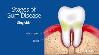 How Gum Disease is Treated with Waterlase  BIOLASE  Patient Education [upl. by Anamor]