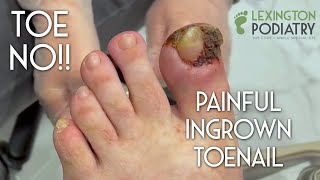 TOE NO Painful Ingrown Toenail Removal [upl. by Harbour625]