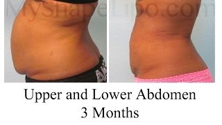 Do I Need Liposuction or Tummy tuck MyShape Lipos Trevor Schmidt PAC Reviews [upl. by Idram515]