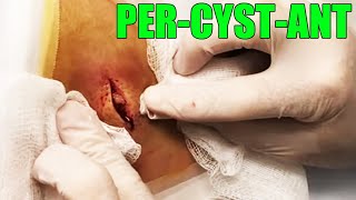 Double Bubble Cyst Dr Gilmore Cyst Removal [upl. by Neelya]